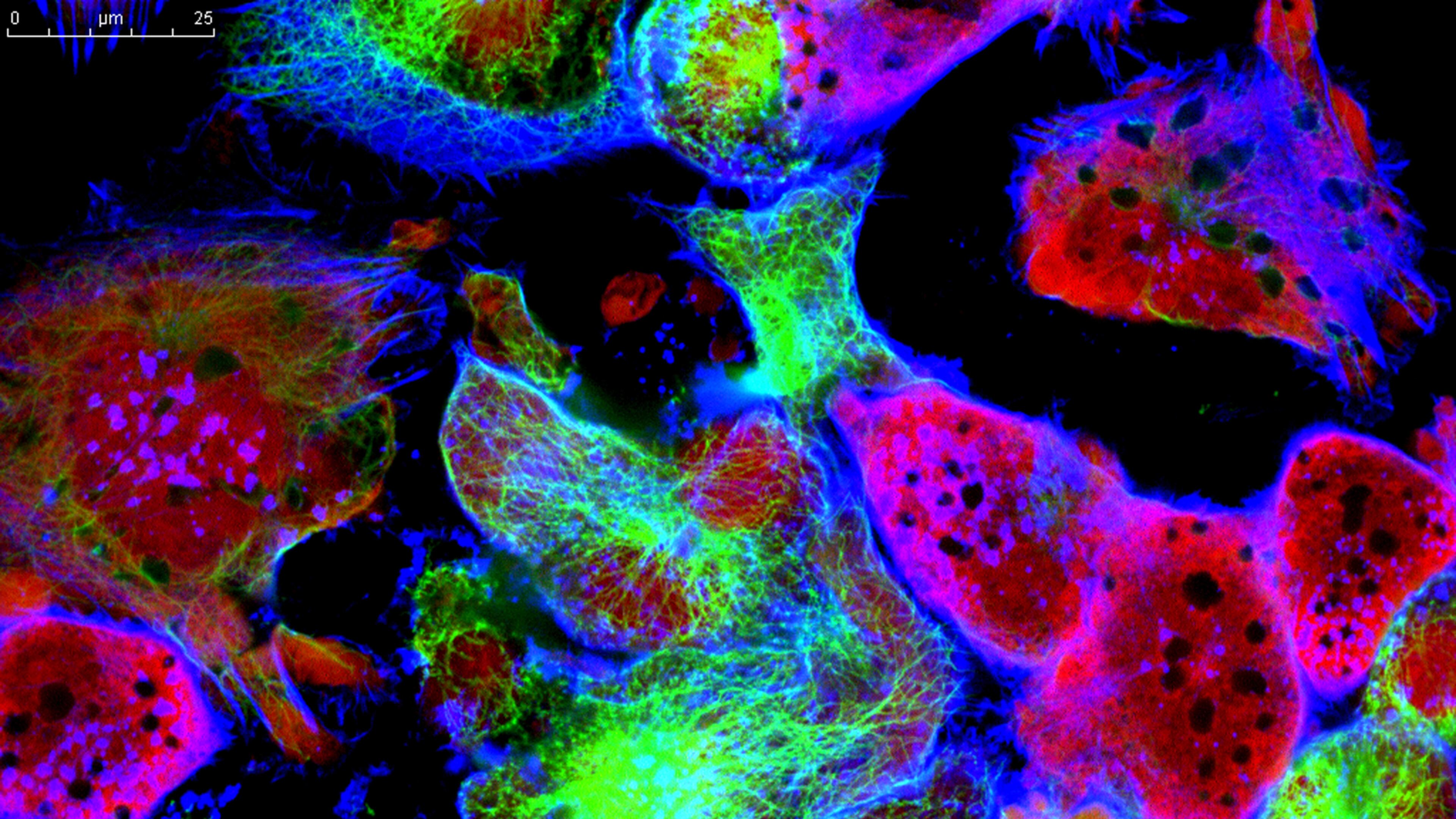 Tumor cells under microscope labeled with fluorescent molecules
