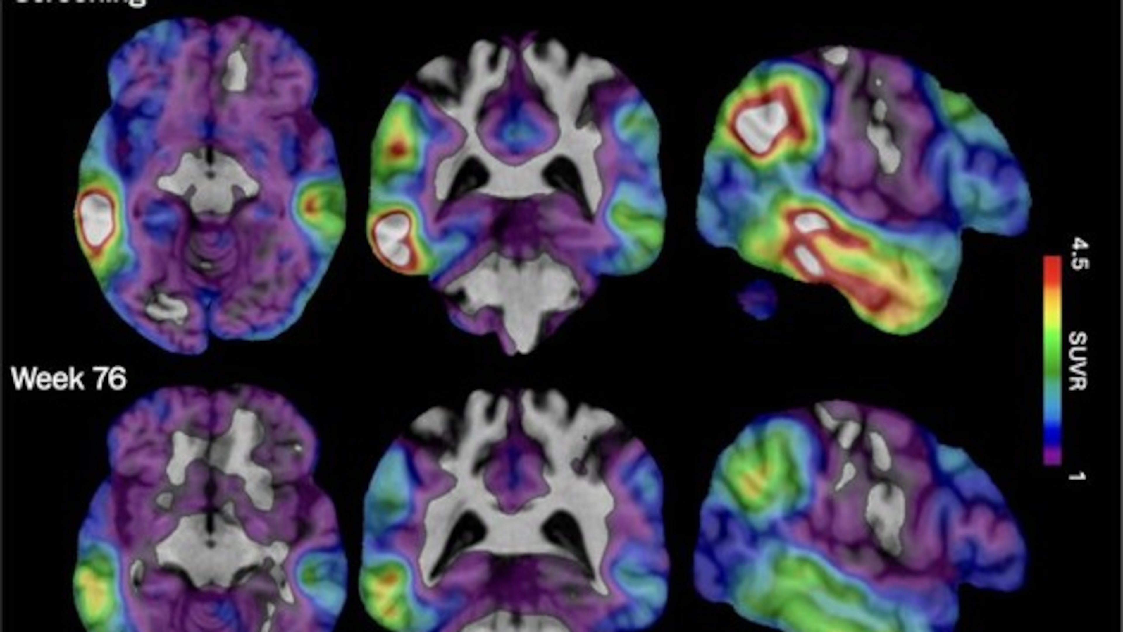 These brain scan images provided by Biogen show how high levels of Alzheimer's-related tau protein, in red, dropped in a recipient of the company's experimental drug diranersen. (Biogen via AP)