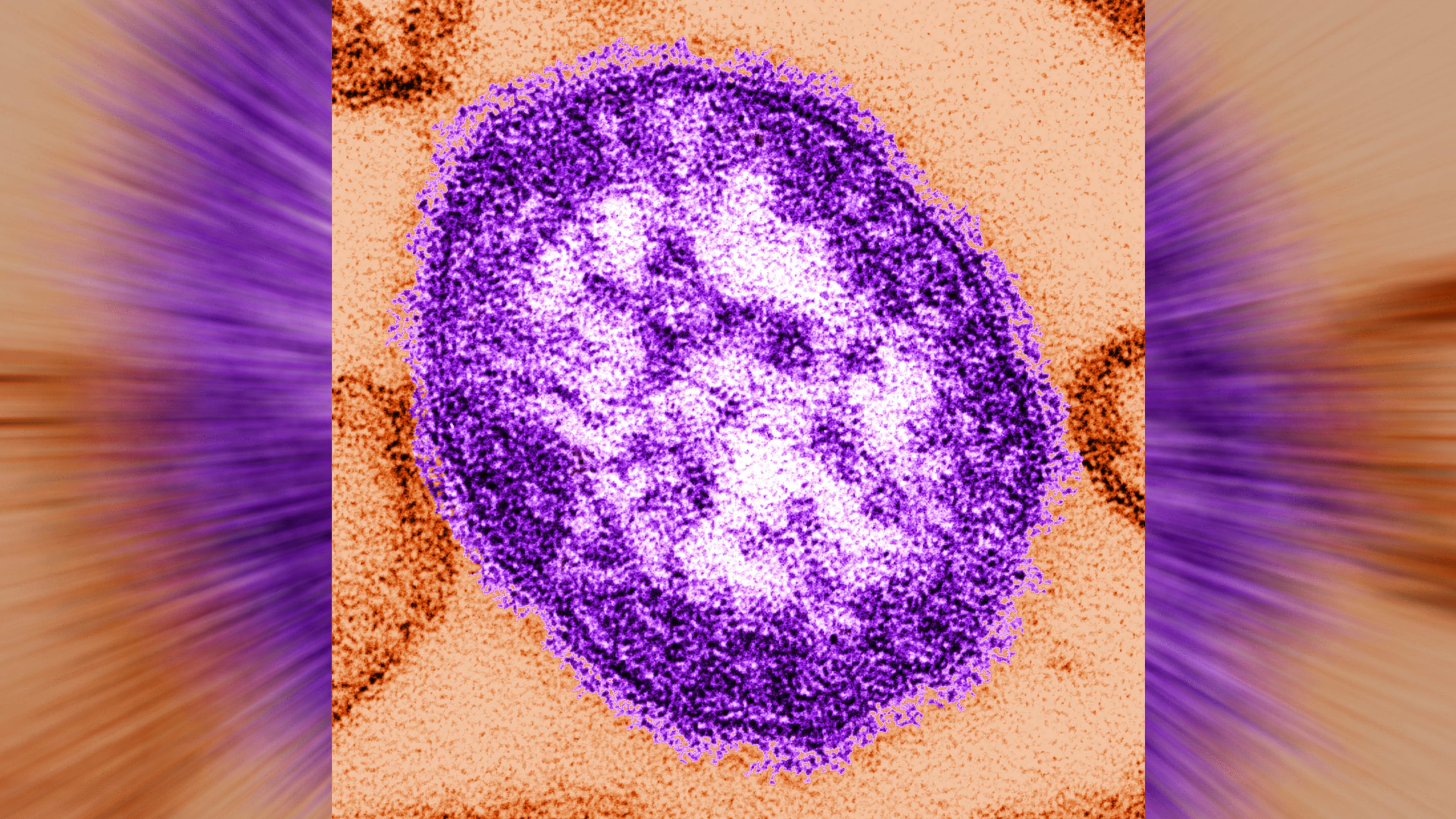 An electron microscope image of a measles virus particle. (Cynthia Goldsmith/Centers for Disease Control and Prevention via AP FILE)