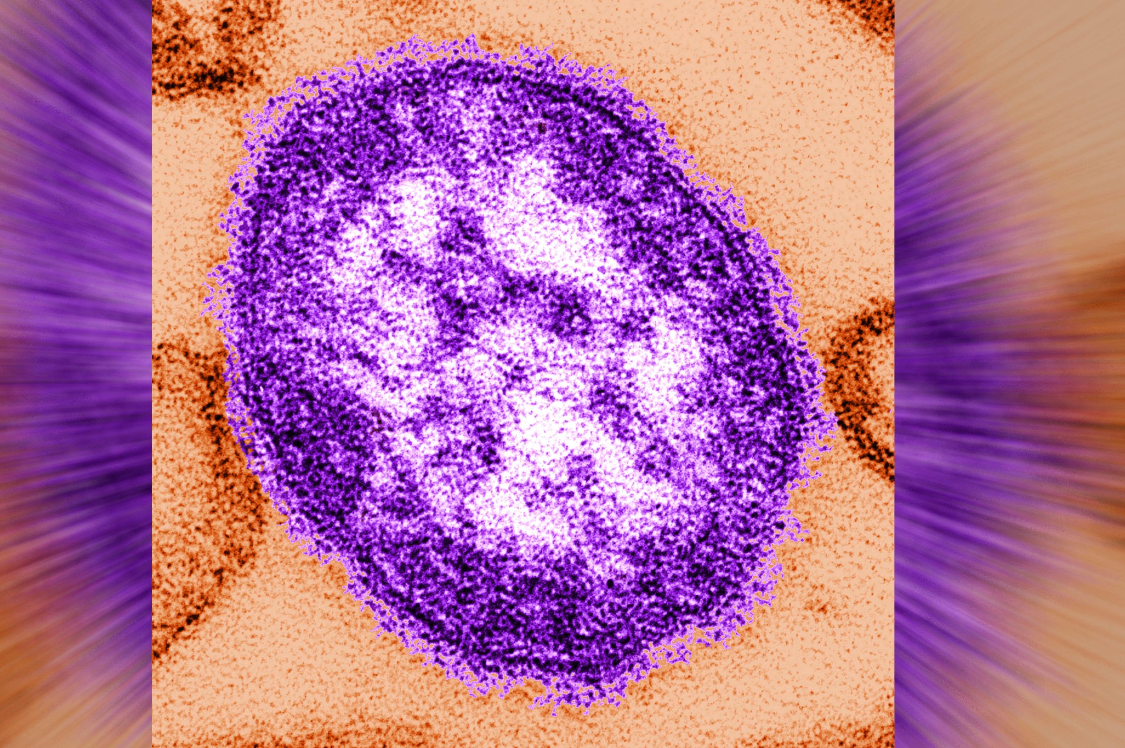 Measles Deaths