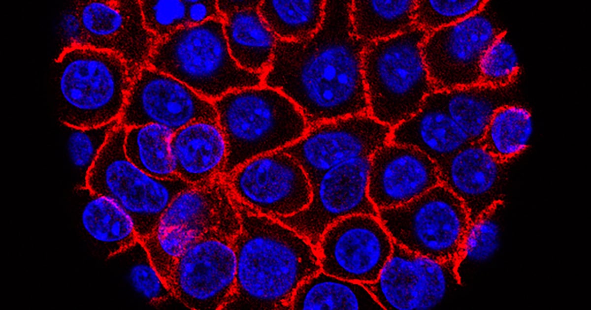 Georgia hospitals test ‘game-changer’ pancreatic cancer drugs