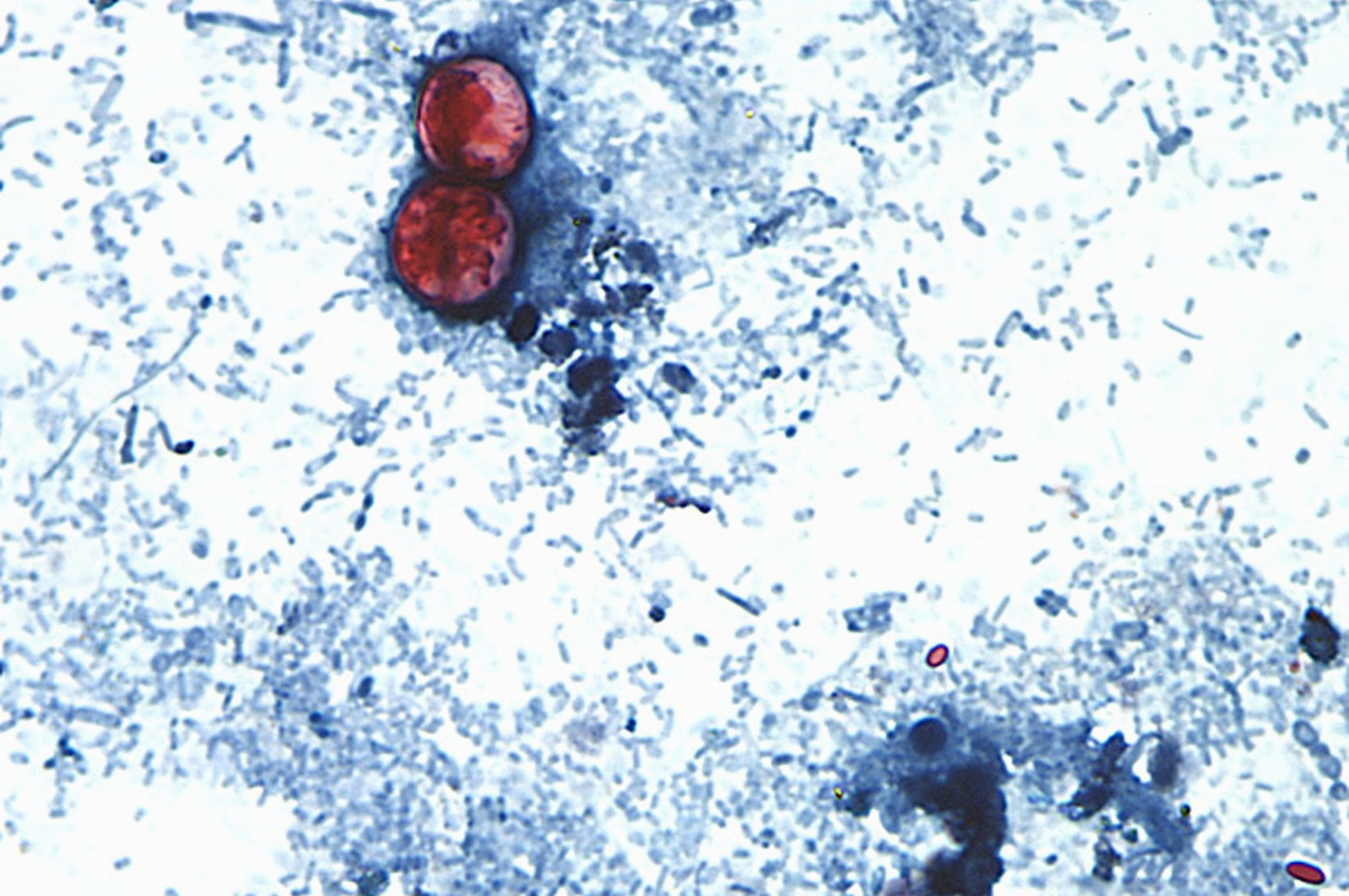 Cyclospora Outbreak