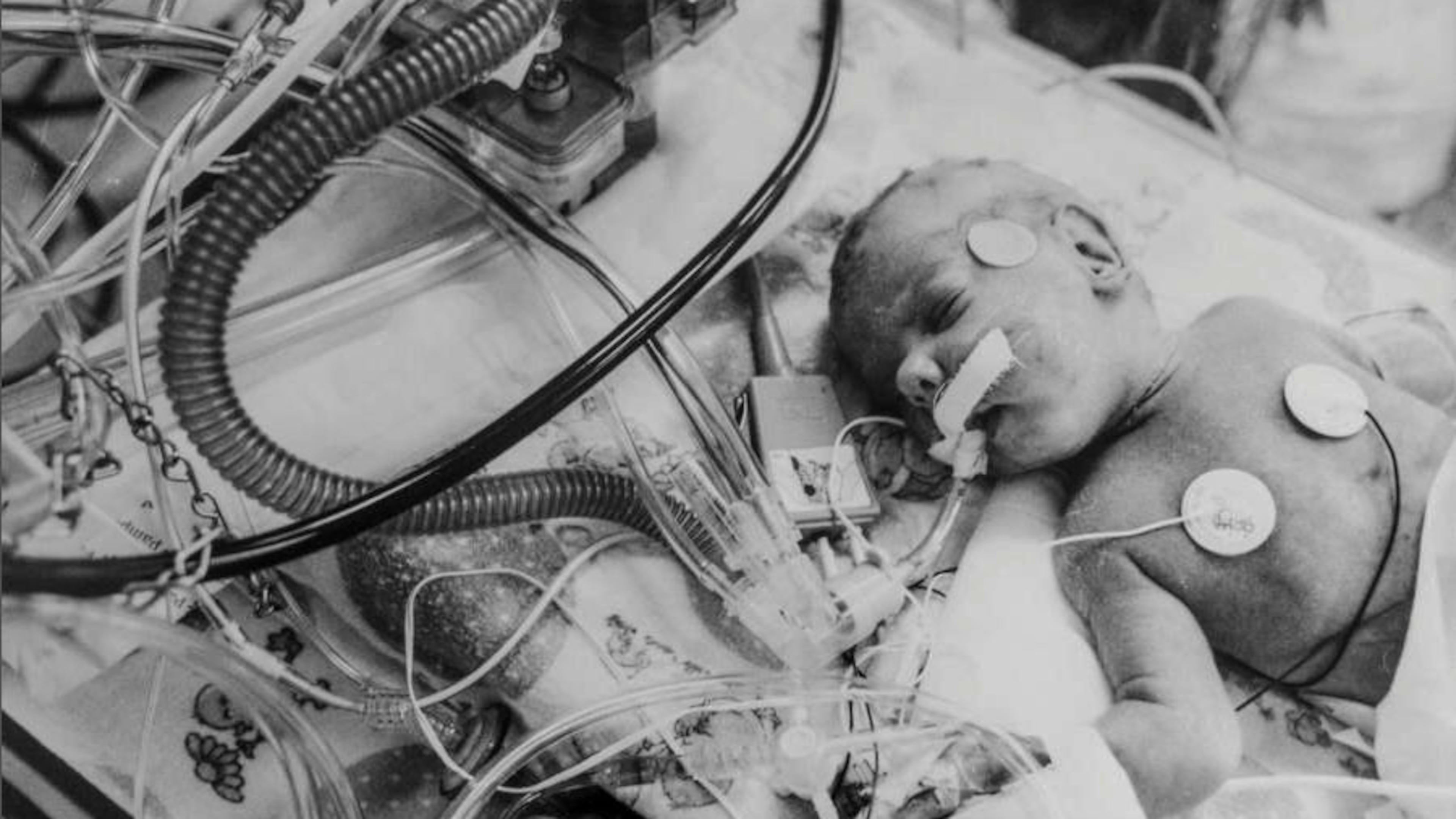 A 1-month-old boy, addicted to cocaine at birth, breathes with the help of a ventilator in an incubator at Grady Memorial Hospital. He was born eight to 10 weeks premature. (Walter Stricklin/AJC file)
