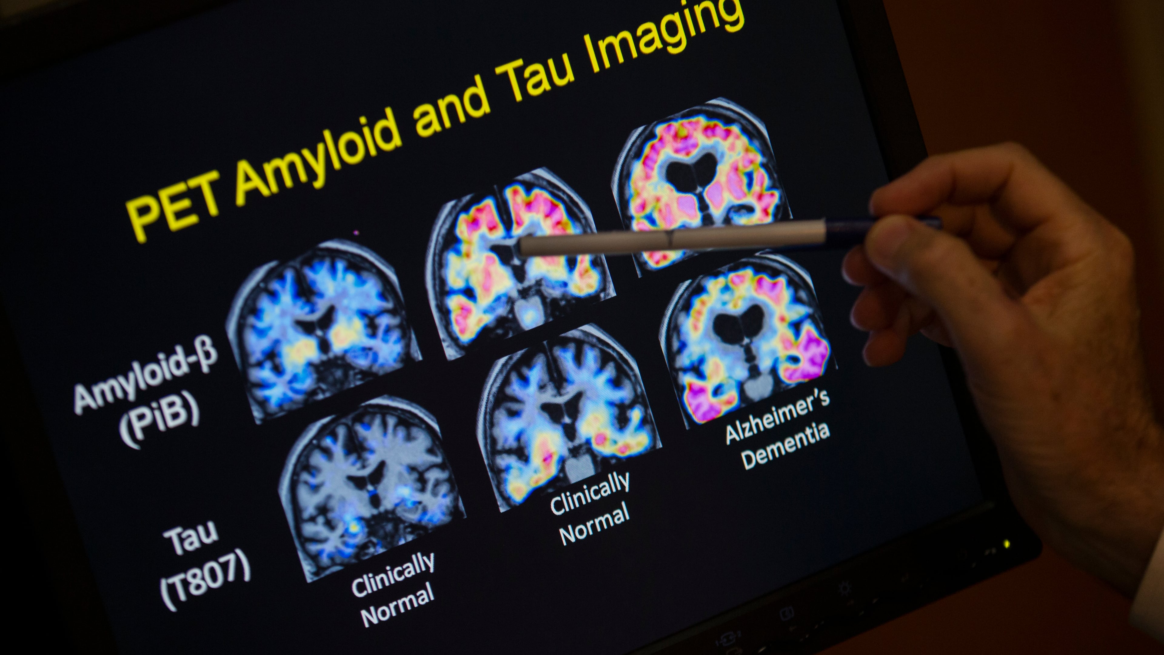 FILE - A doctor points to PET scan results that are part of a study on Alzheimer's disease at Georgetown University Hospital, on Tuesday, May 19, 2015, in Washington. (AP Photo/Evan Vucci, File)