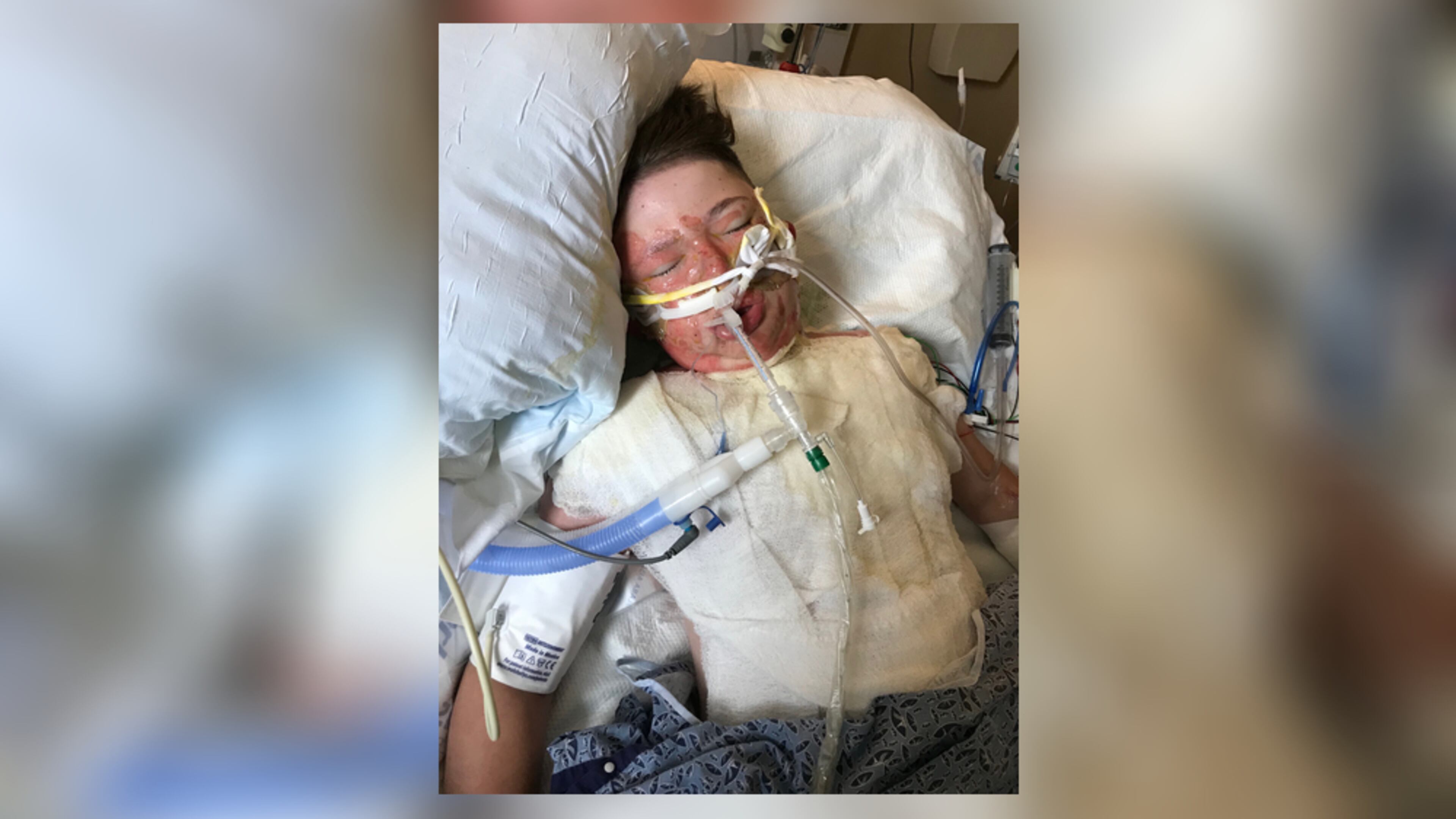 Ray Corfino was badly burned while using rubbing alcohol to light a piece of paper. The bottle exploded, burning Ray's face, neck, chest and arms. (Credit: Family photo)