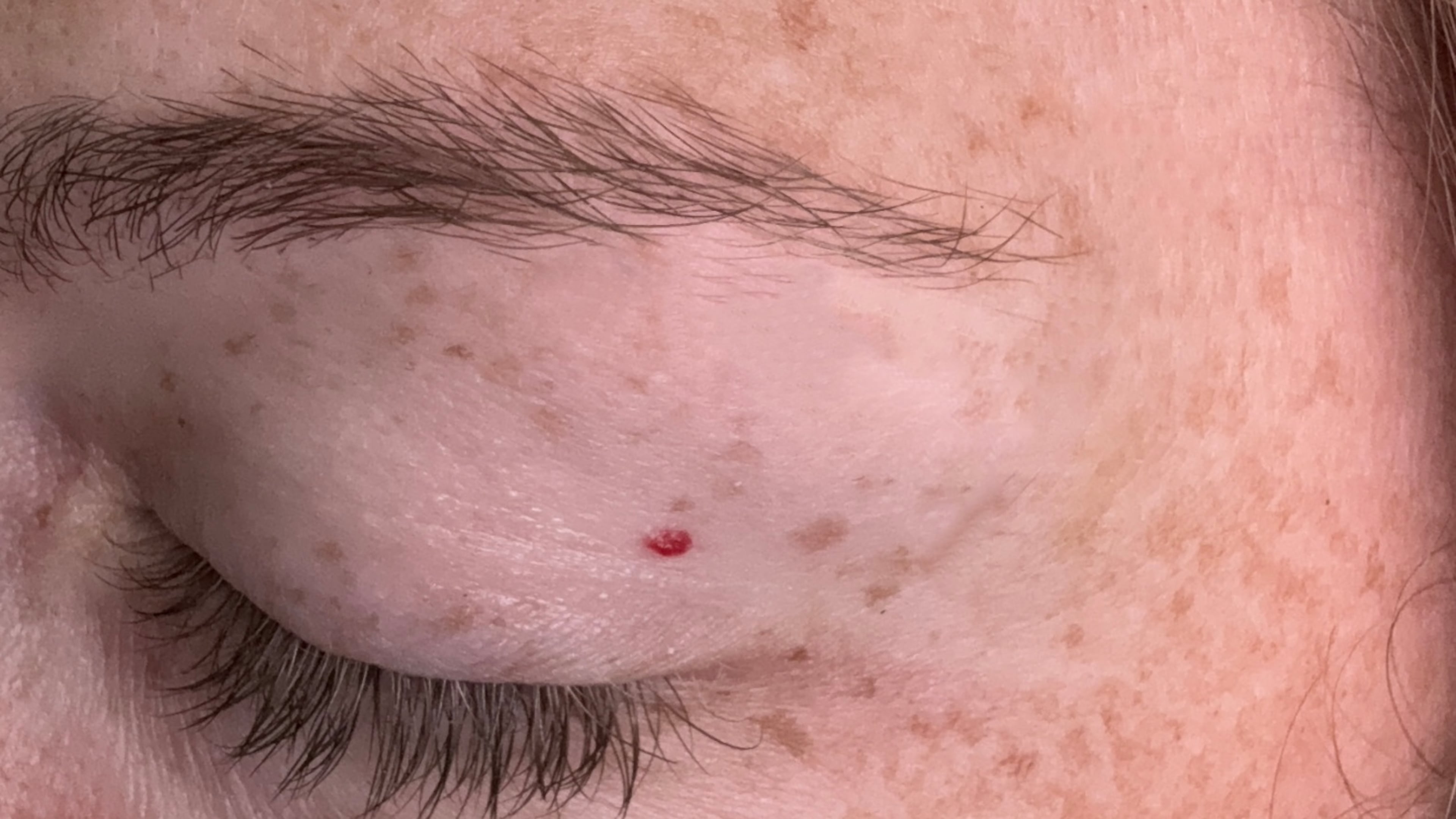 The red dot on my eyelid is a cherry angioma, which is a common, tiny cluster of blood vessels. “These come and stay,” the dermatologist said. “Totally harmless.” (Avery Newmark/AJC)