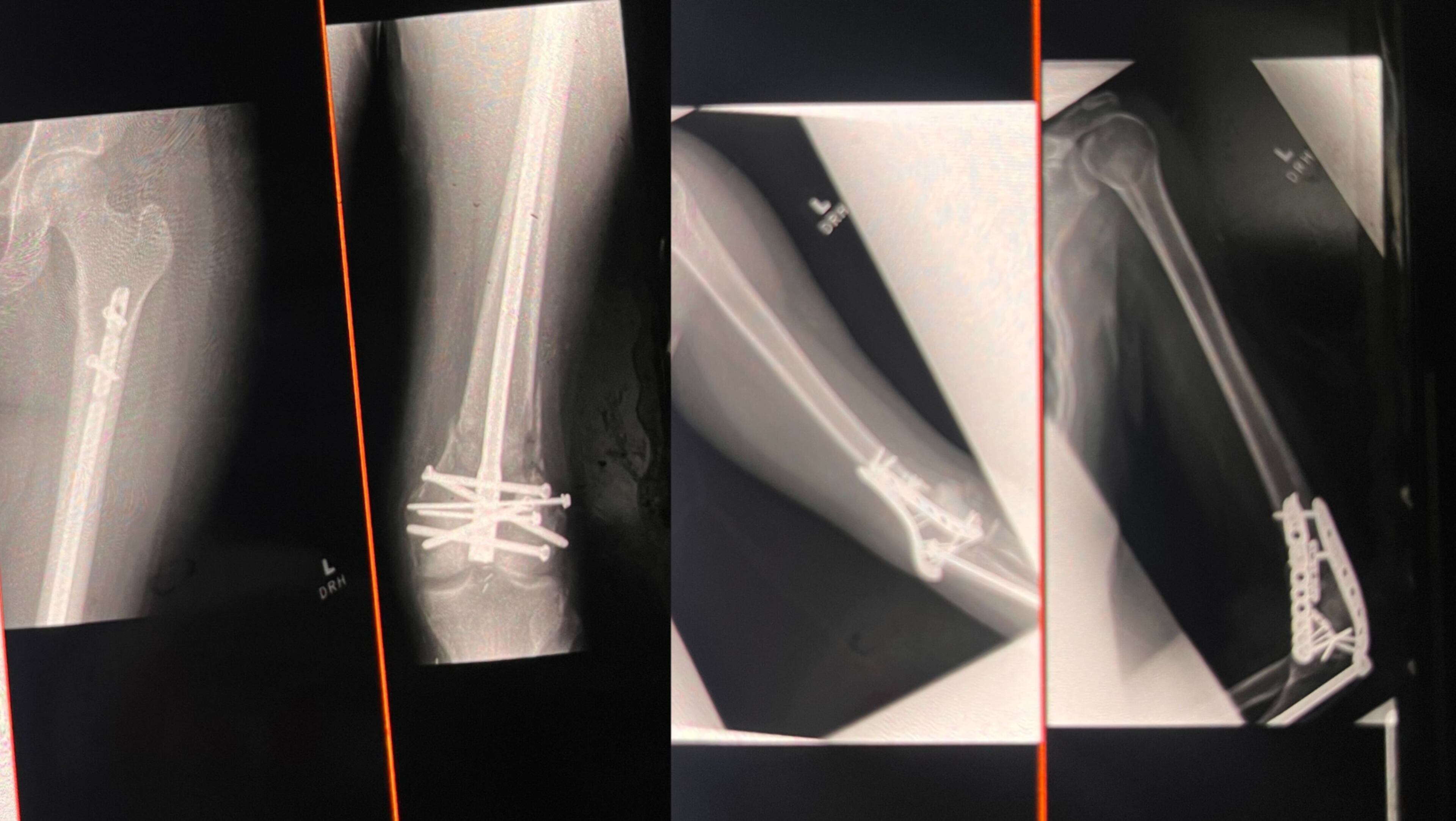 De’Avion Frezell has a metal rod in her left leg and several screws in her left knee (pictured left). Her left elbow also has a metal plate and screws (pictured right). (Courtesy)