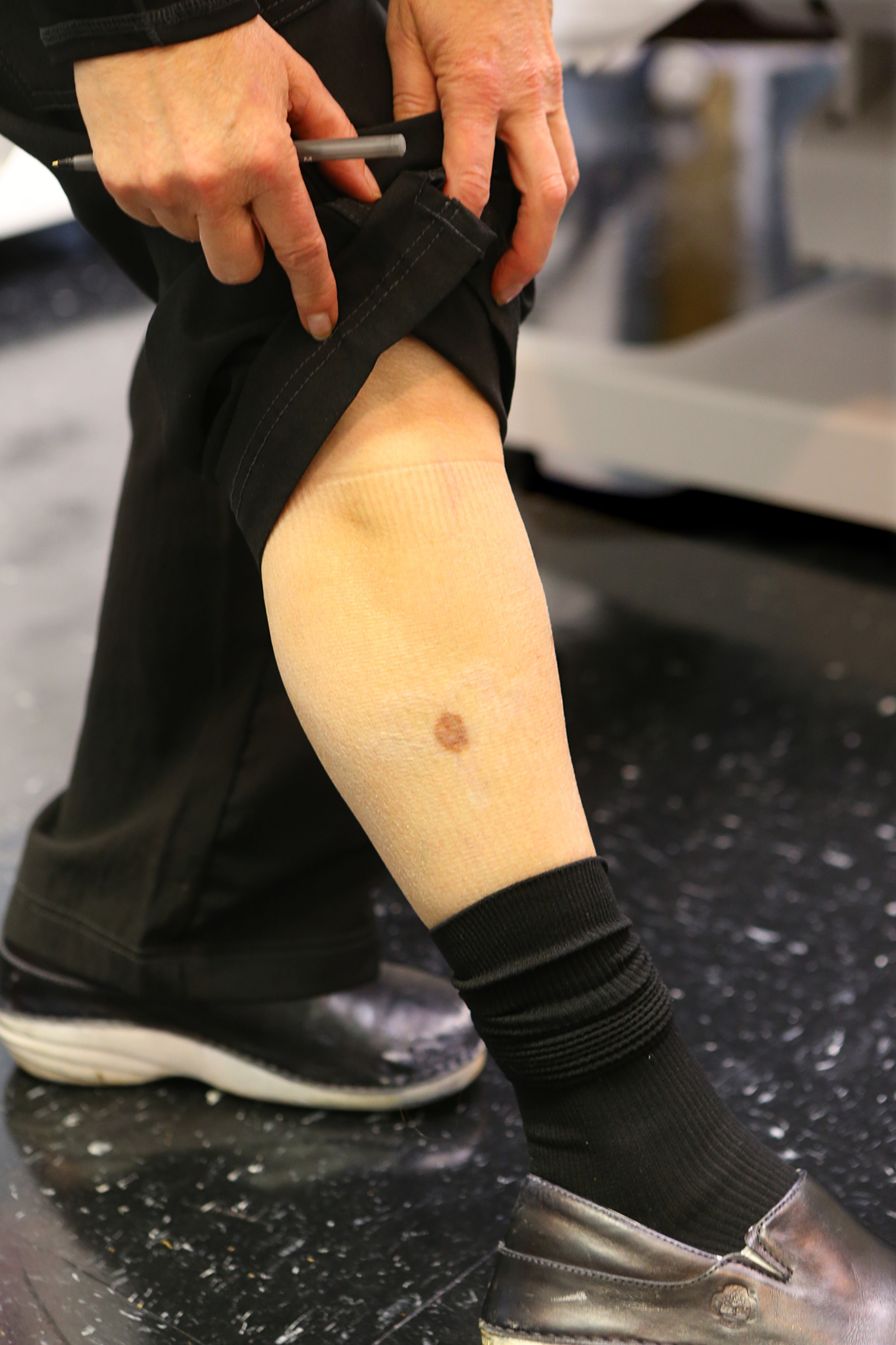 Medical assistant Lori Phillips shows off a small spot that is all that remains of a large "his and hers heart." She is in the process of having removed from her leg at Atlanta Dermatology & Laser Surgery in Tucker. CURTIS COMPTON / CCOMPTON@AJC.COM
