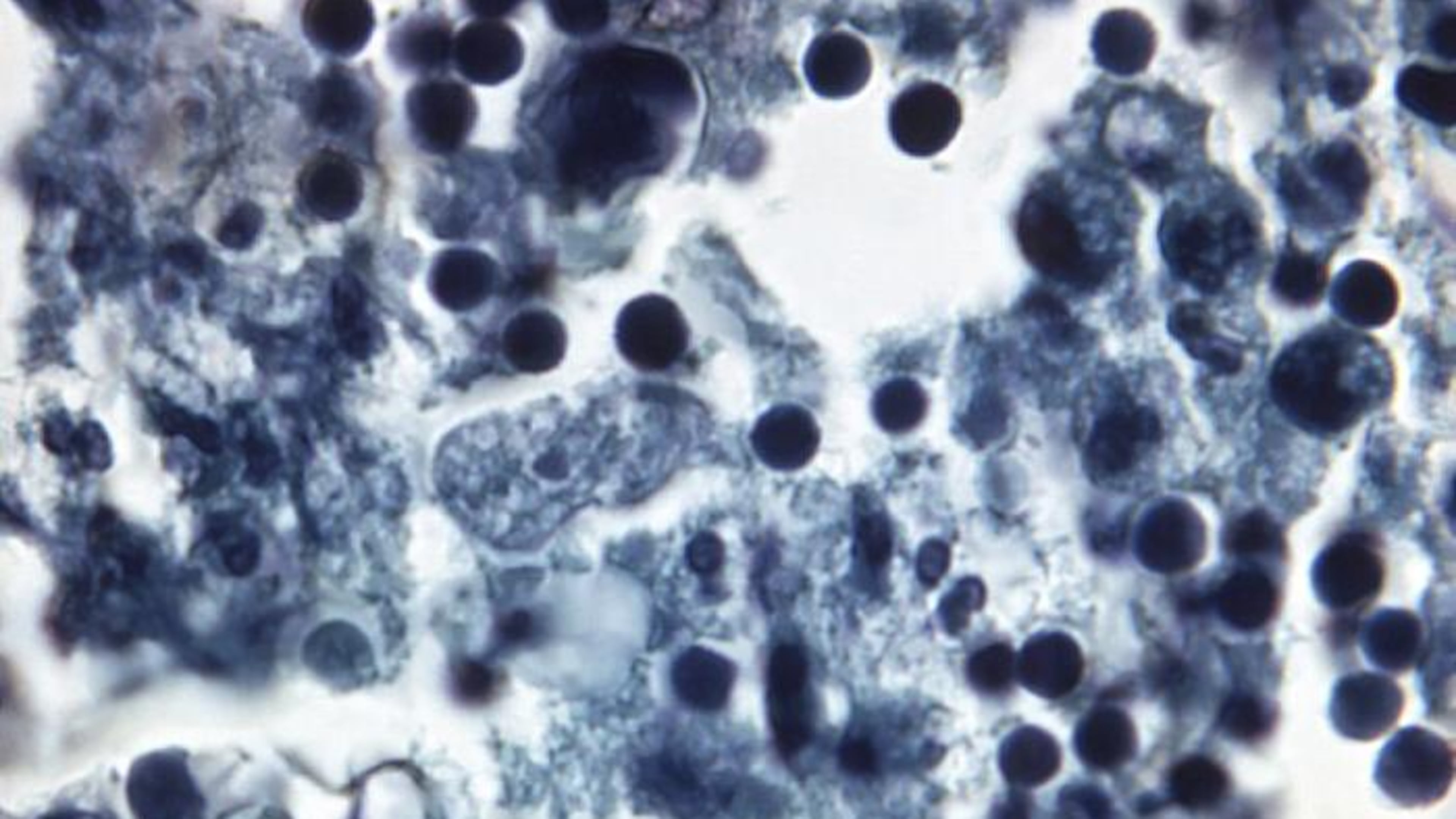 Magnified 1180X, this 1973 H&E-stained photomicrograph revealed the presence of Naegleria gruberi, free-living amoebae in a human brain tissue specimen, in a case of primary amoebic meningoencephalitis (PAM). Free-living amoebae belonging to the genera Acanthamoeba, Balamuthia, and Naegleria, are important causes of disease in humans and animals.