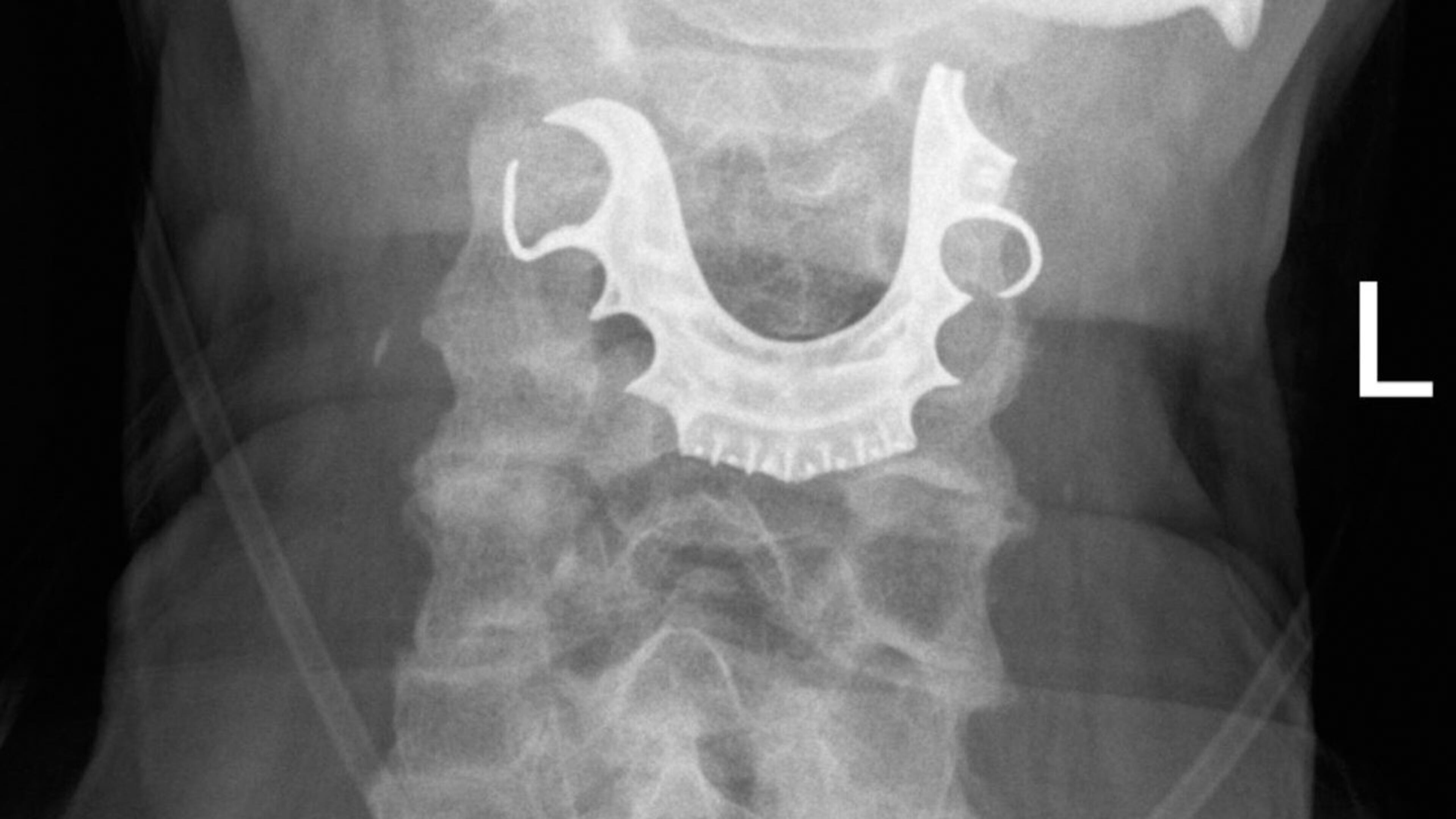 A recently published BMJ report says a man's partial dentures got stuck in his throat during surgery and weren’t discovered until eight days later.