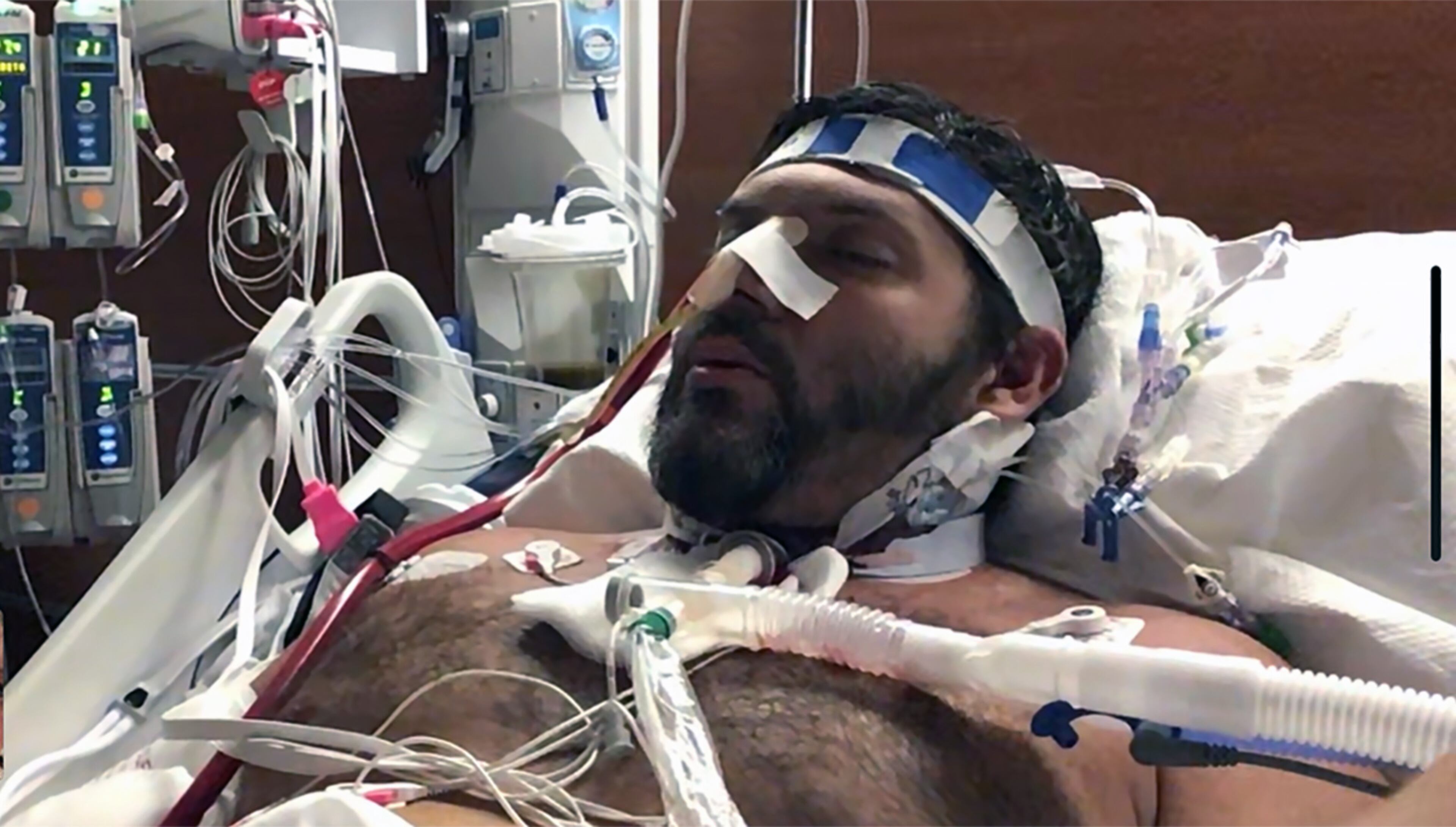 Greer Smith is connected to an ECMO machine for COVID-19 treatment at Northside Hospital Gwinnett in August 2021. He was initially hospitalized at Jeff Davis Hospital, a small facility in Hazlehurst, but his doctor feared he would die if he didn't get use of an ECMO machine, which acts for the lungs, filtering the blood and putting in oxygen. The red tube by the side of Smith's head is carrying Smith's blood, newly oxygenated from the machine, into his jugular vein. (Handout)