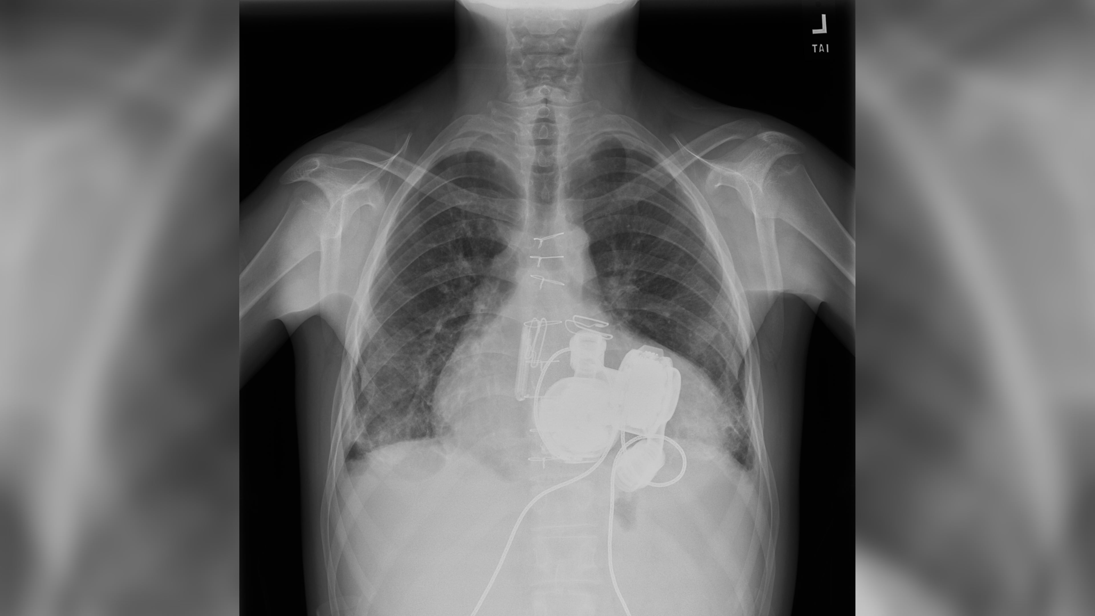 A scan of Andrew Miles' chest showing his implanted artificial heart device. (Courtesy of Emory Healthcare)