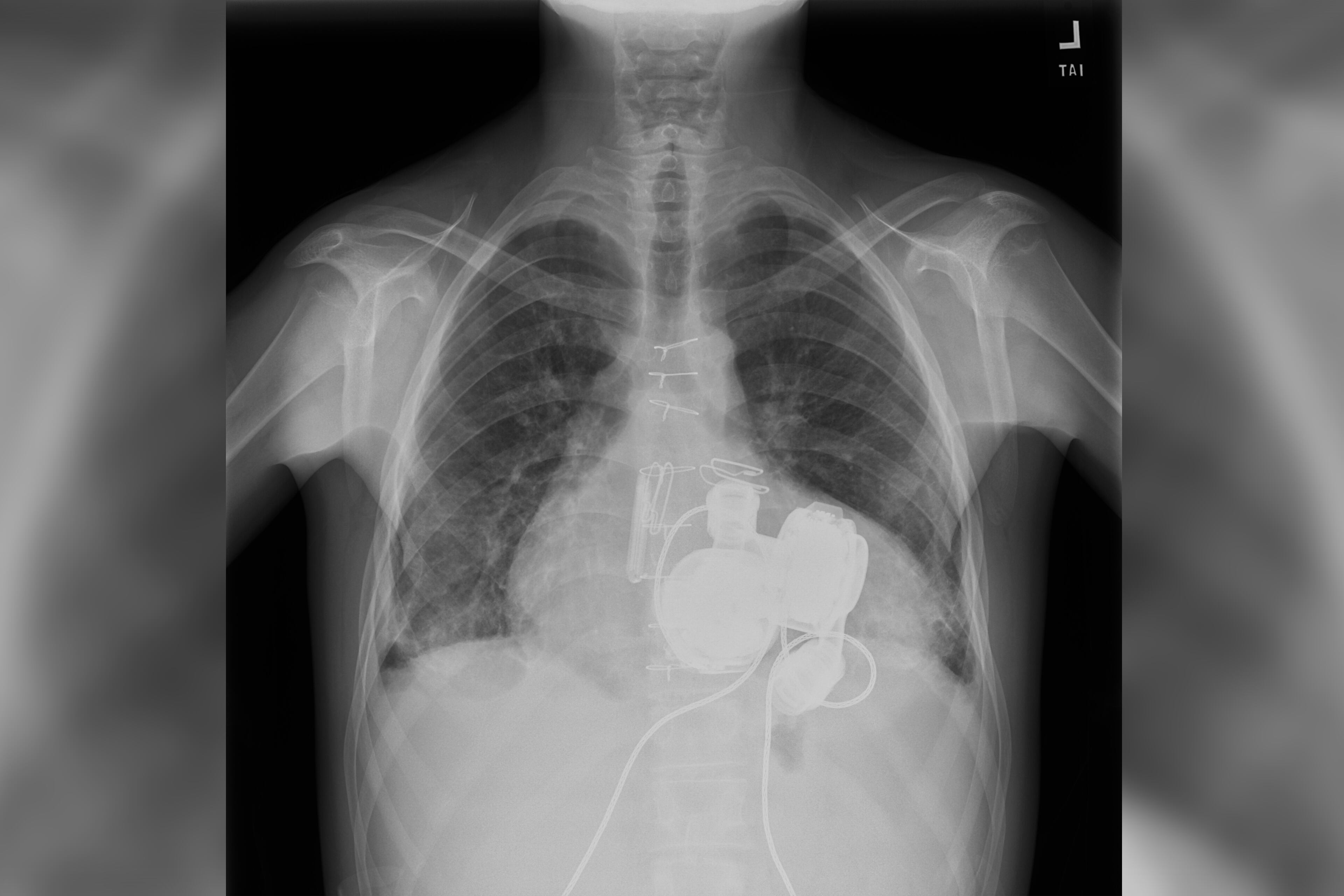 A scan of Andrew Miles' chest showing his implanted artificial heart device. (Courtesy of Emory Healthcare)