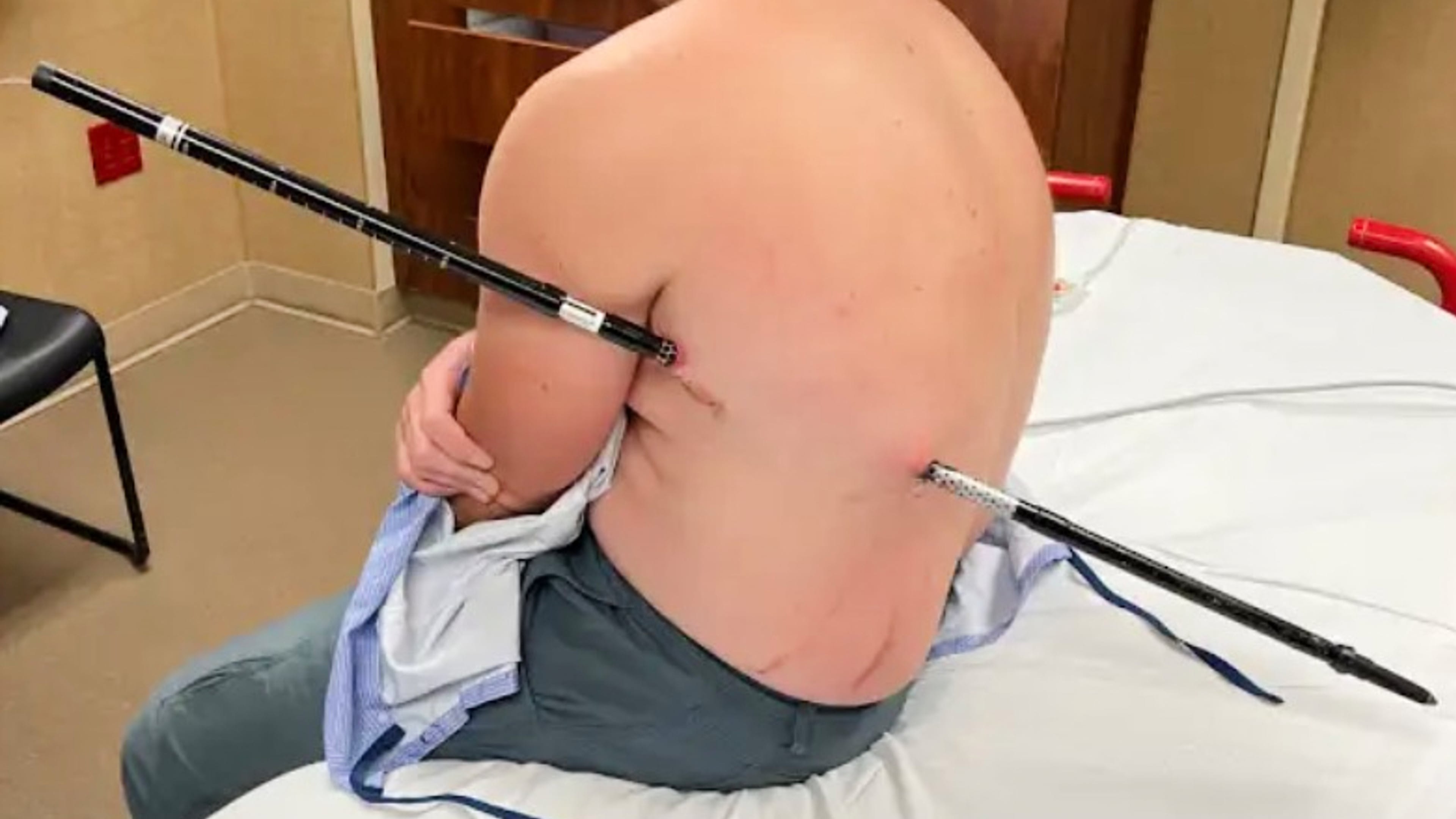 This photo provided by David Cifaldi shows Cifaldi while he was being treated Monday, July 20, 2026, at St. Vincent Regional Hospital in Billings, Mont. (Jessee Ross via AP)
