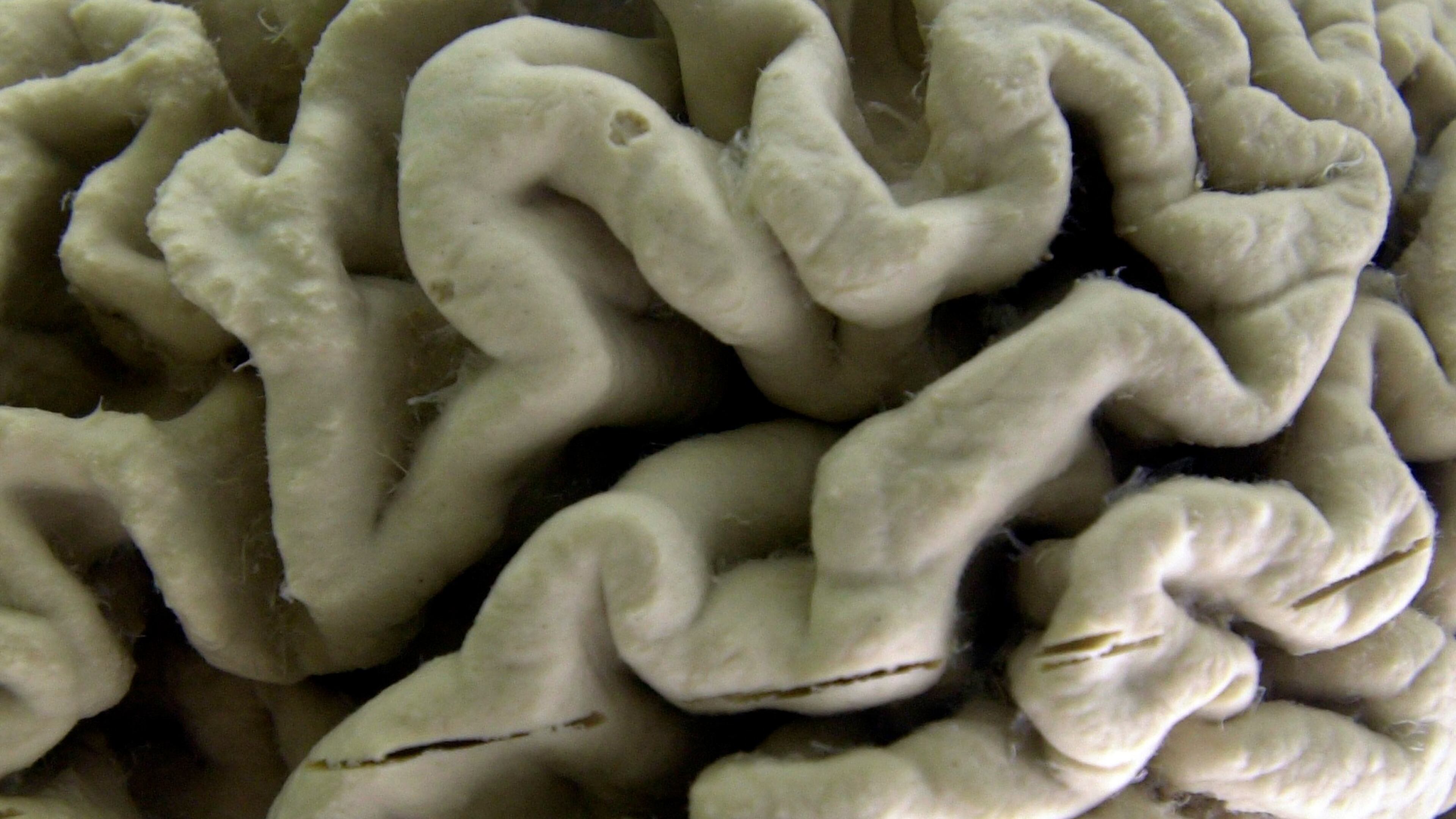 FILE - A human brain affected by Alzheimer's disease is displayed at the Museum of Neuroanatomy at the University at Buffalo in Buffalo, N.Y., on Oct. 7, 2003. (AP Photo/David Duprey, File)