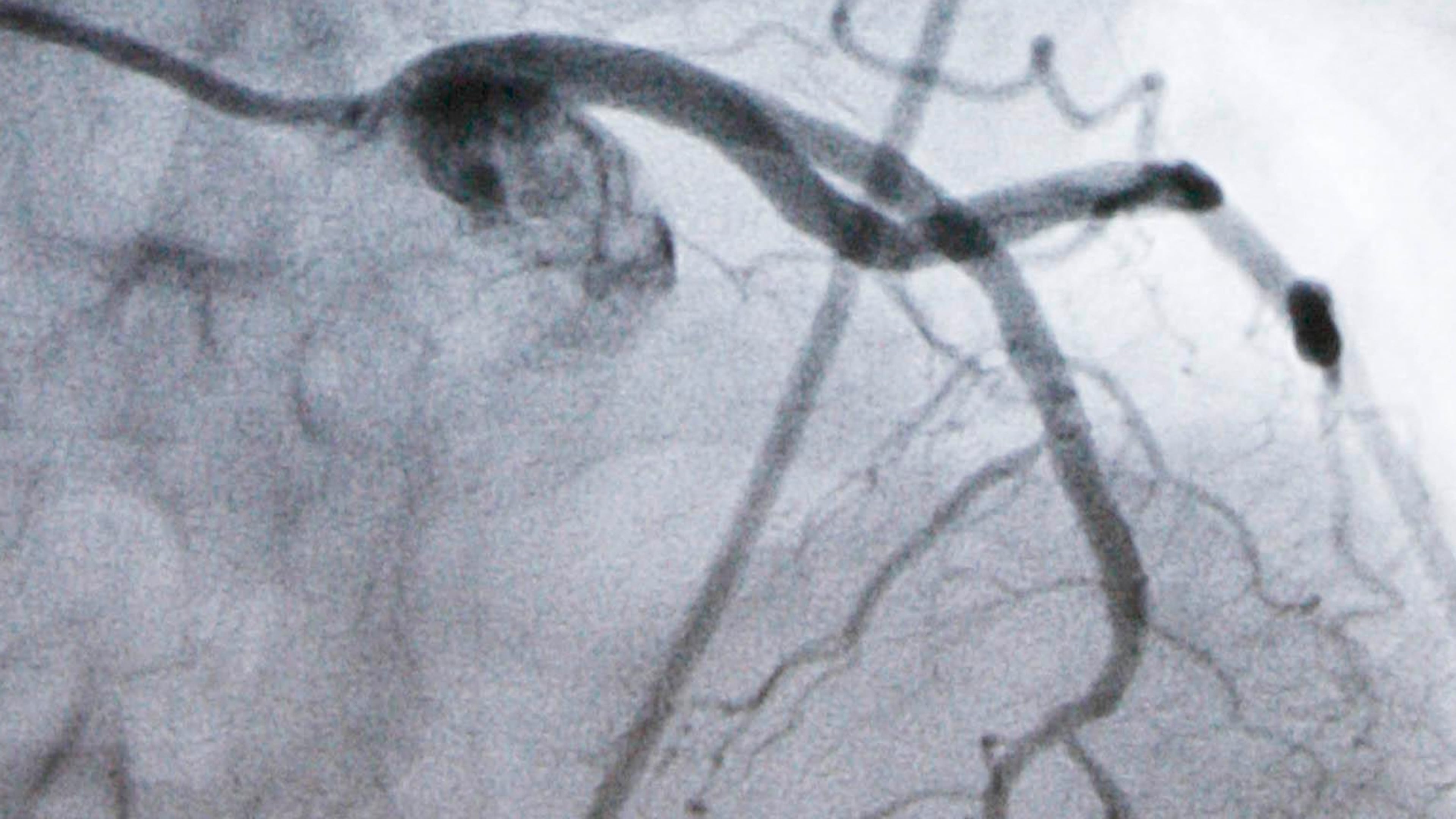 FILE - A monitor shows an artery during a catheterization lab heart procedure in Burlington, Vt., Tuesday, Sept. 23, 2008. (AP Photo/Toby Talbot, File)