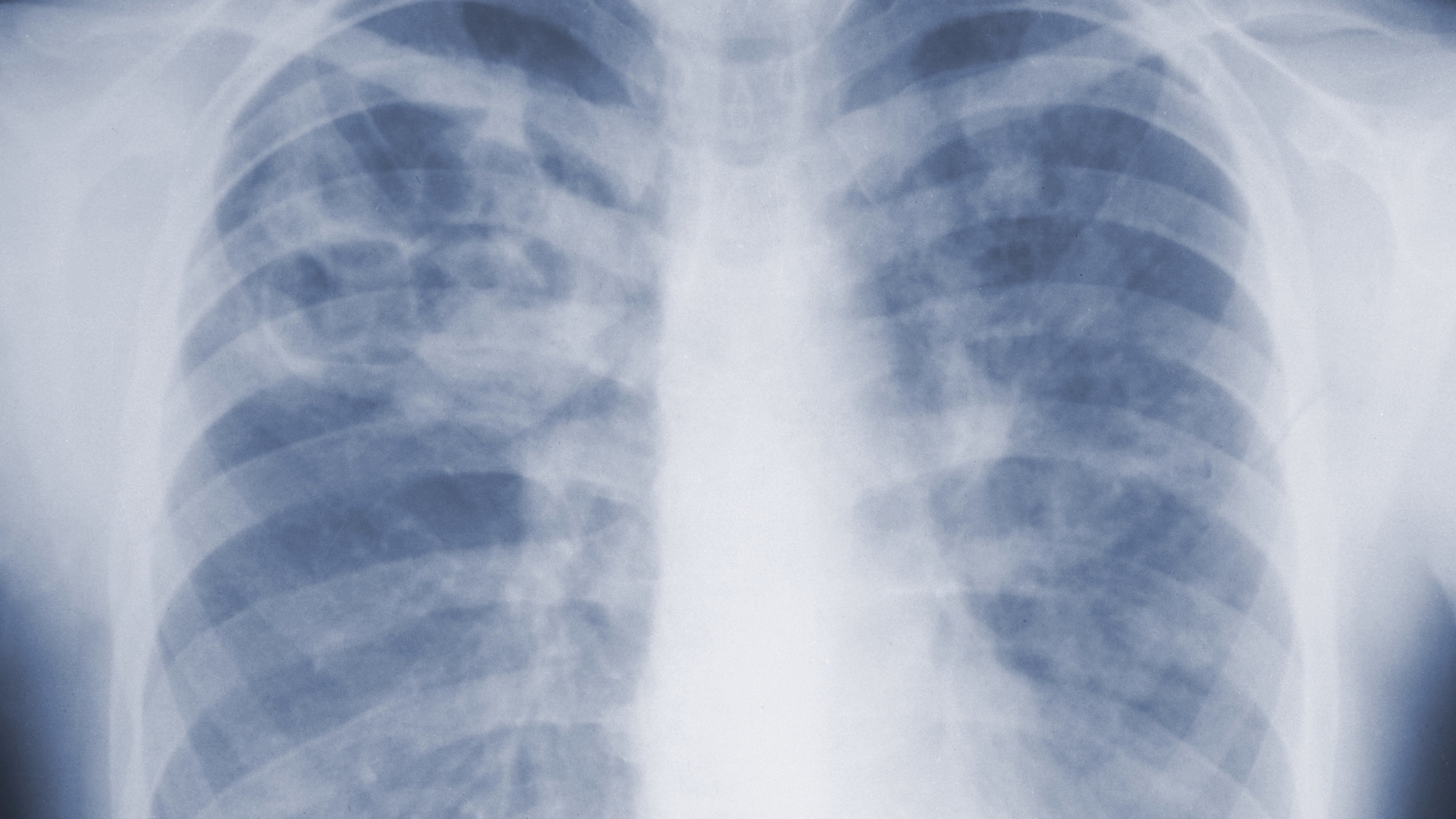 This 1967 chest x-ray photo provided by the U.S. Centers for Disease Control and Prevention shows pulmonary aspergillosis caused by a fungal organism of the genus Aspergillus. (CDC via AP)