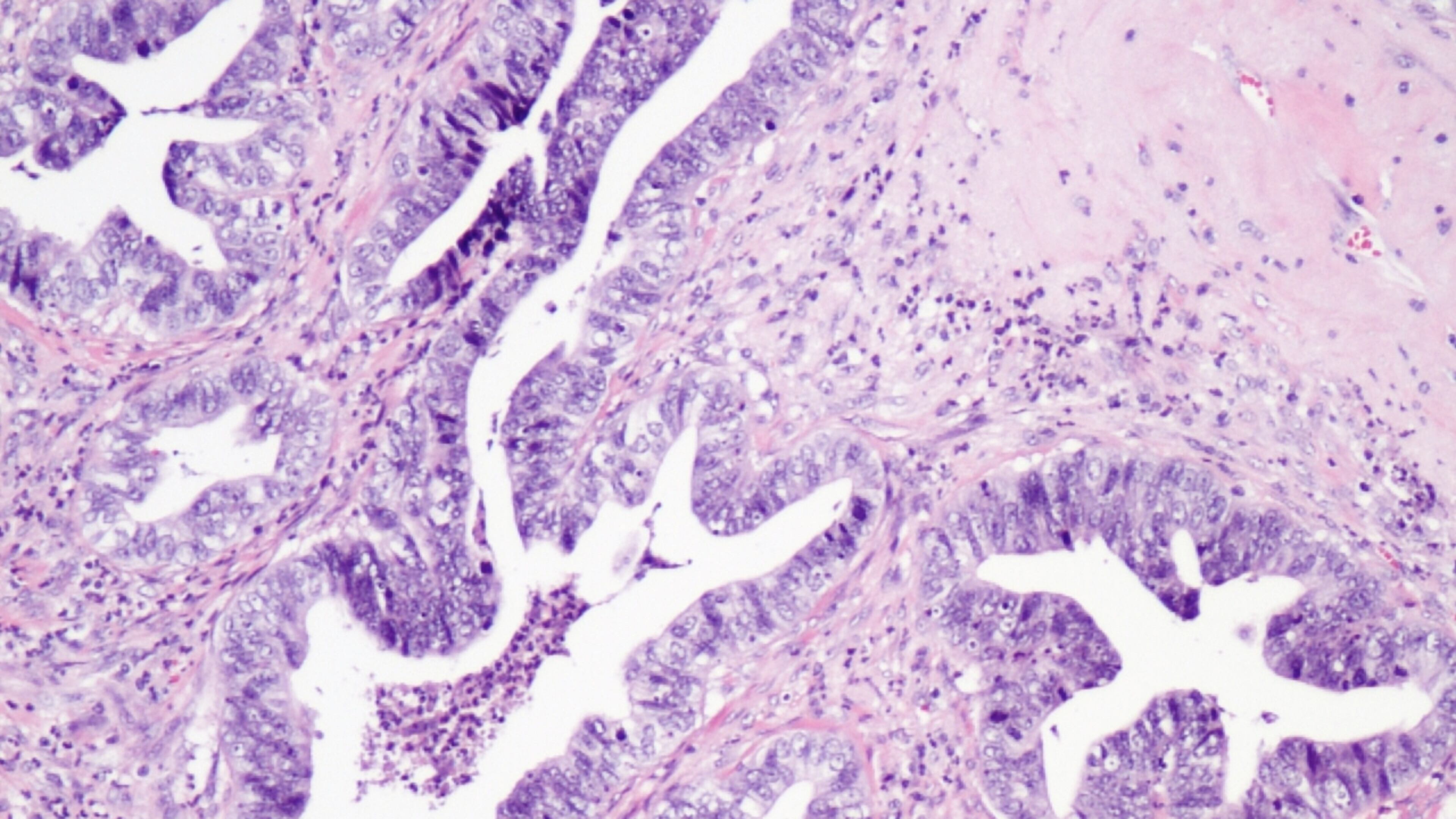 Cervical cancer cells