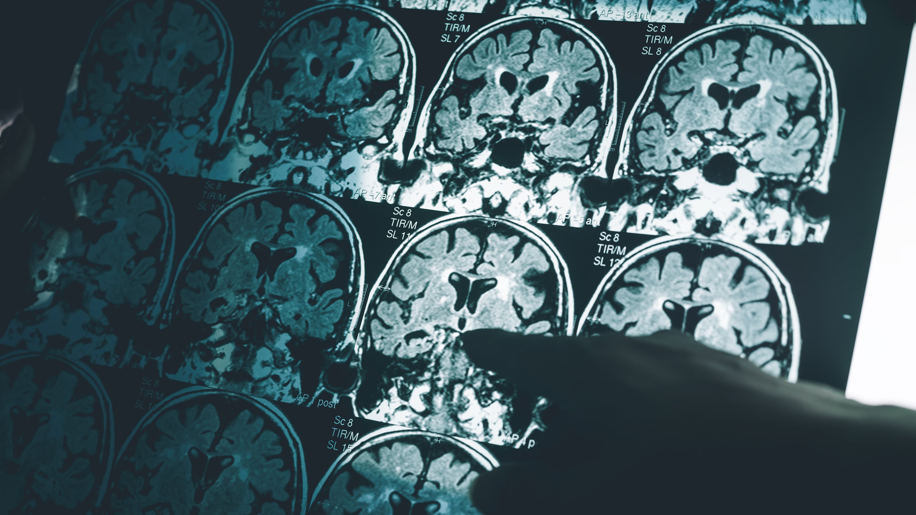 A new study is offering hope for a simple and accurate blood test that can diagnose Alzheimer’s disease in its early stage. (Atthapon Raksthaput/Dreamstime/TNS)