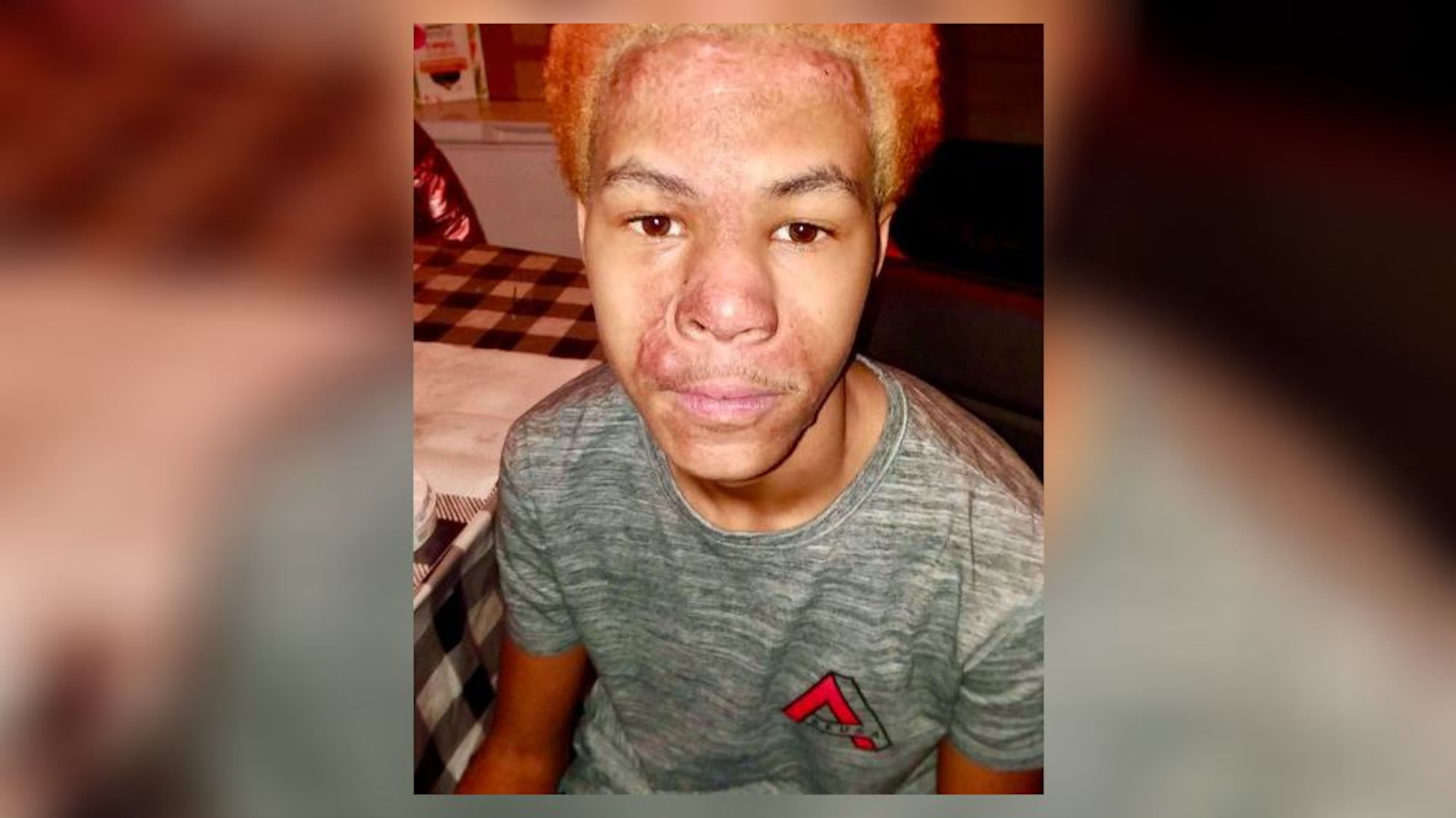 Malachi McFadden was left with burns on his face, neck and arms after a chemistry demonstration at Redan High School went awry in August 2019. The Georgia Court of Appeals ruled Thursday that the teacher who conducted the demonstration is not liable for McFadden's injuries.
