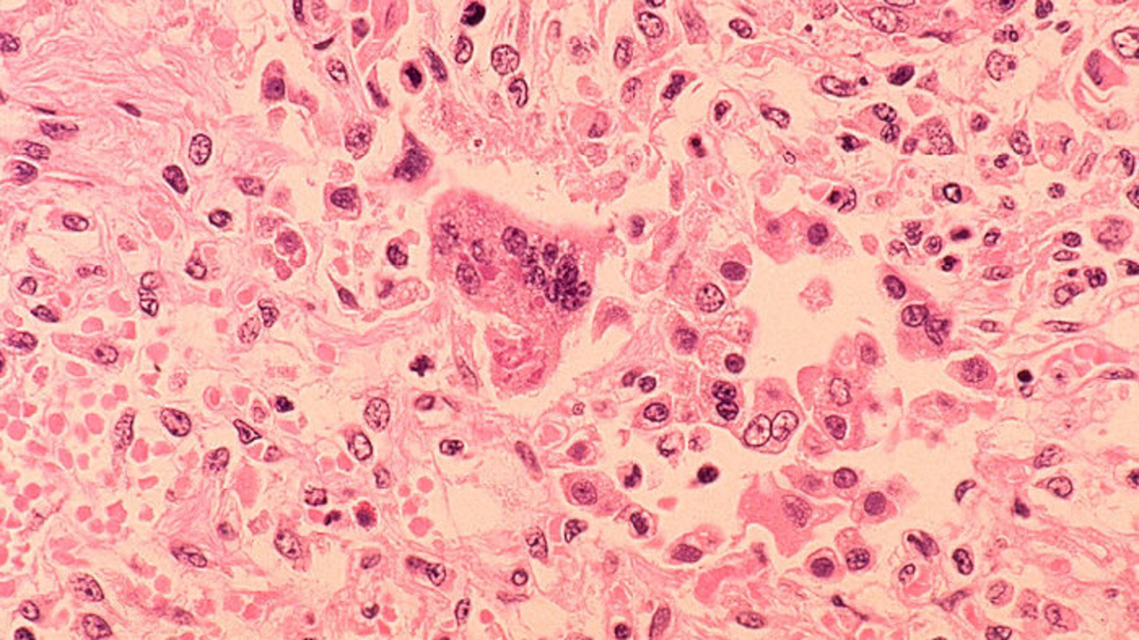 The number of reported measles cases in the United States has spiked to its second-highest level since 2000, according to the Centers for Disease Control and Prevention.