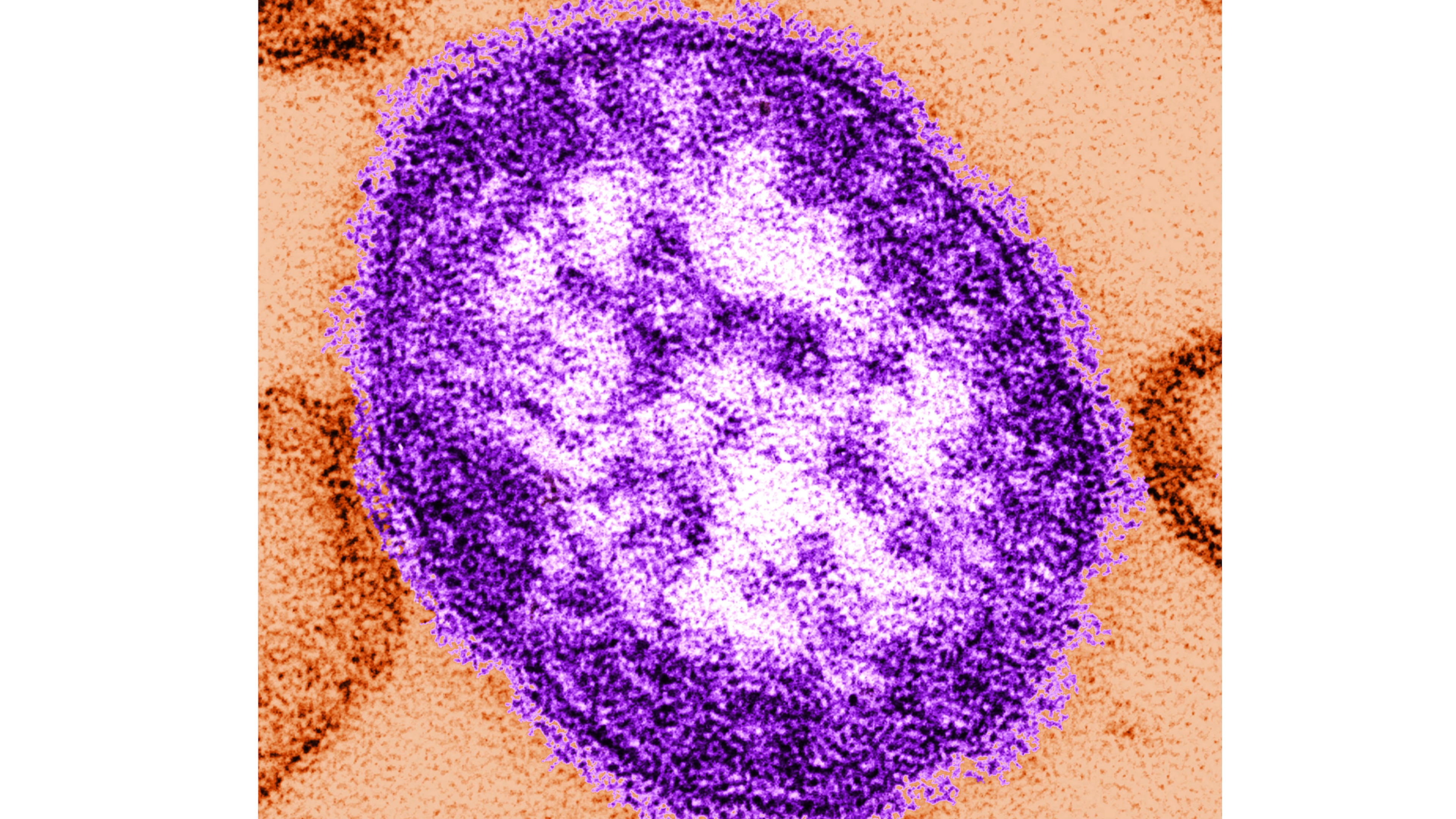 An electron microscope image of a measles virus particle. (Cynthia Goldsmith/Centers for Disease Control and Prevention via AP, File)