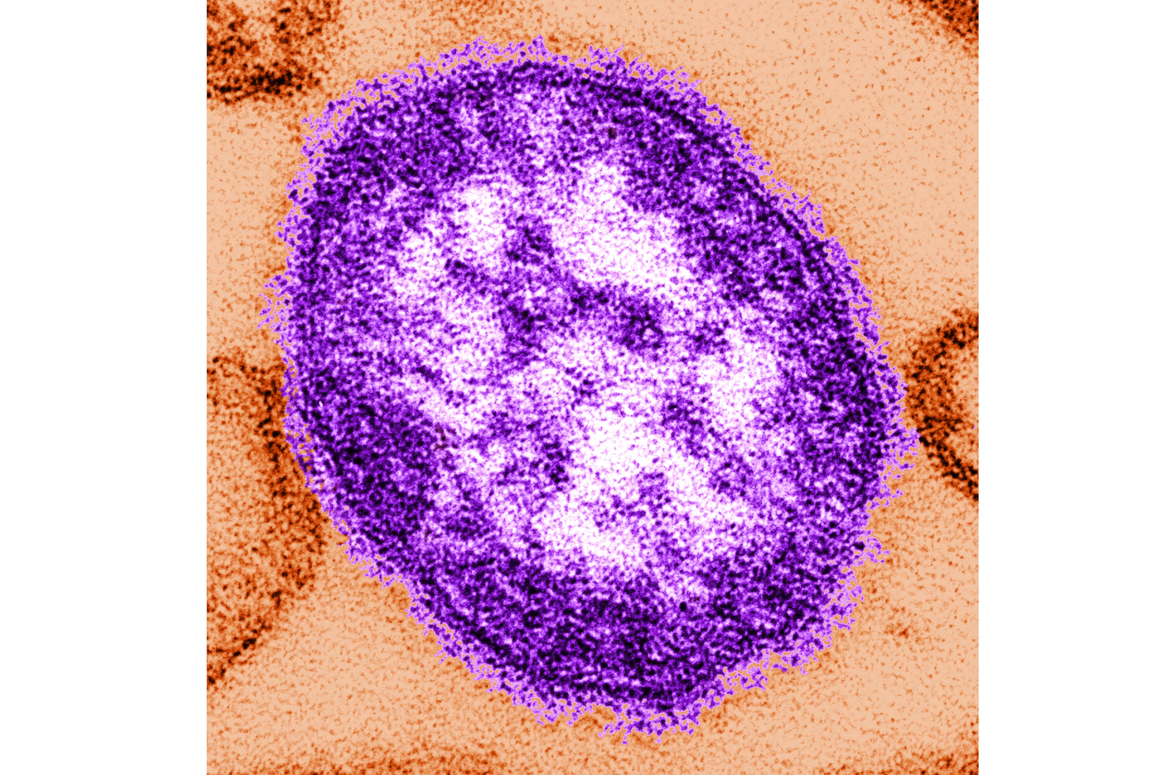 Measles Deaths