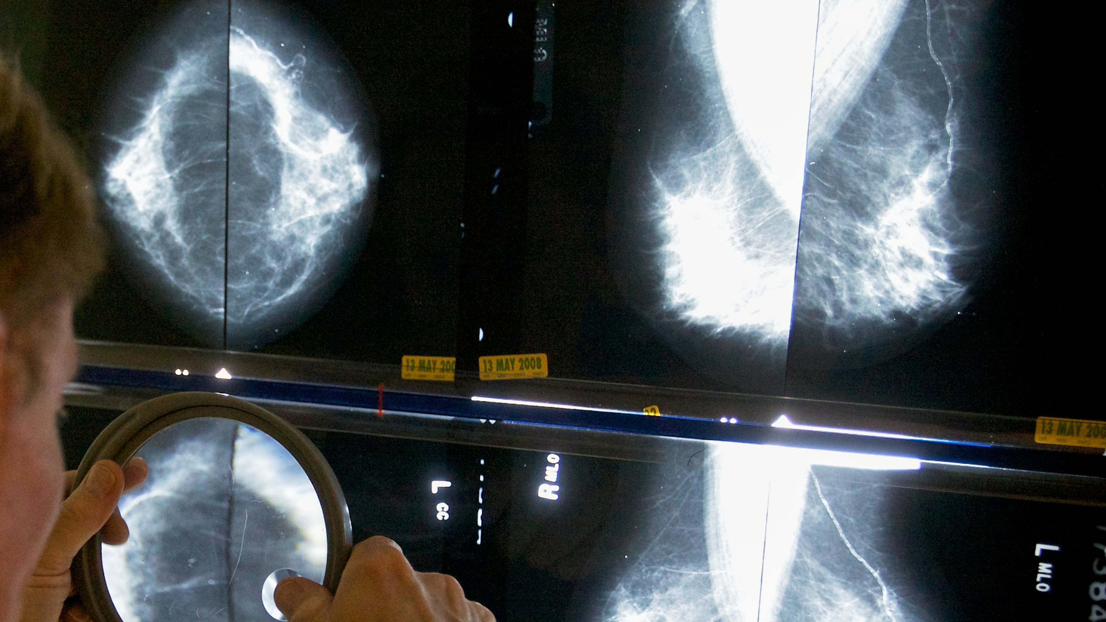 FILE - A radiologist uses a magnifying glass to check mammograms for breast cancer in Los Angeles, May 6, 2010. (AP Photo/Damian Dovarganes, File)