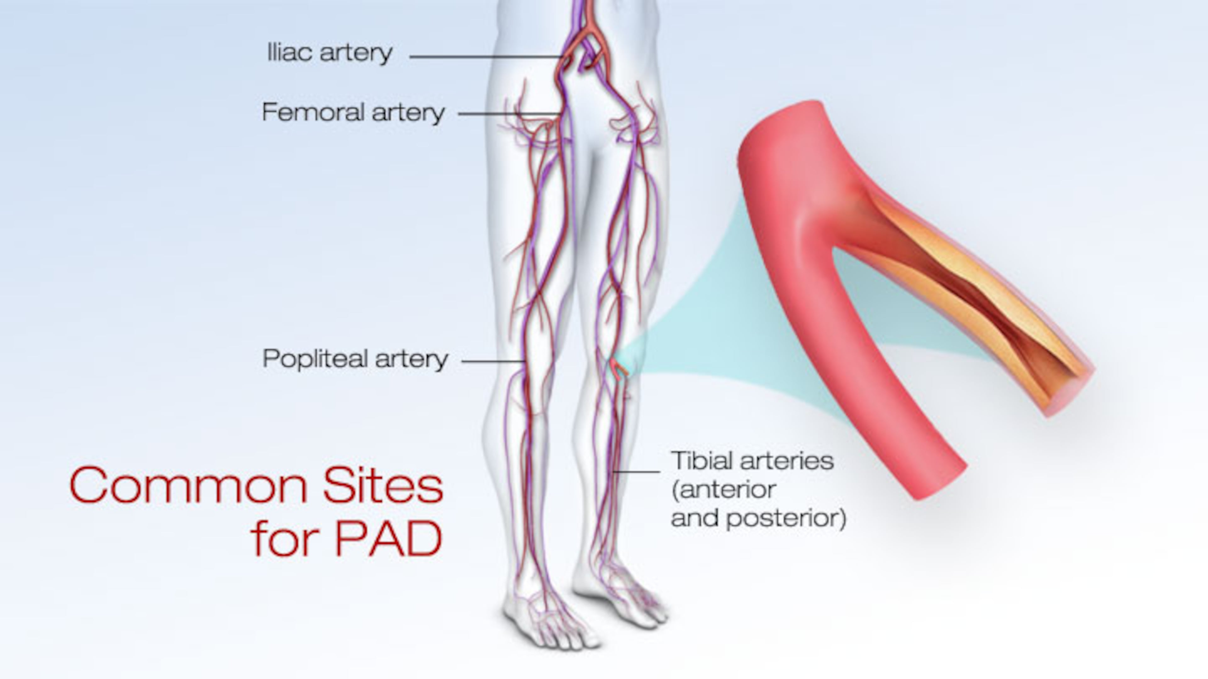 PAD graphic, provided by the American Heart Association, metro Atlanta chapter