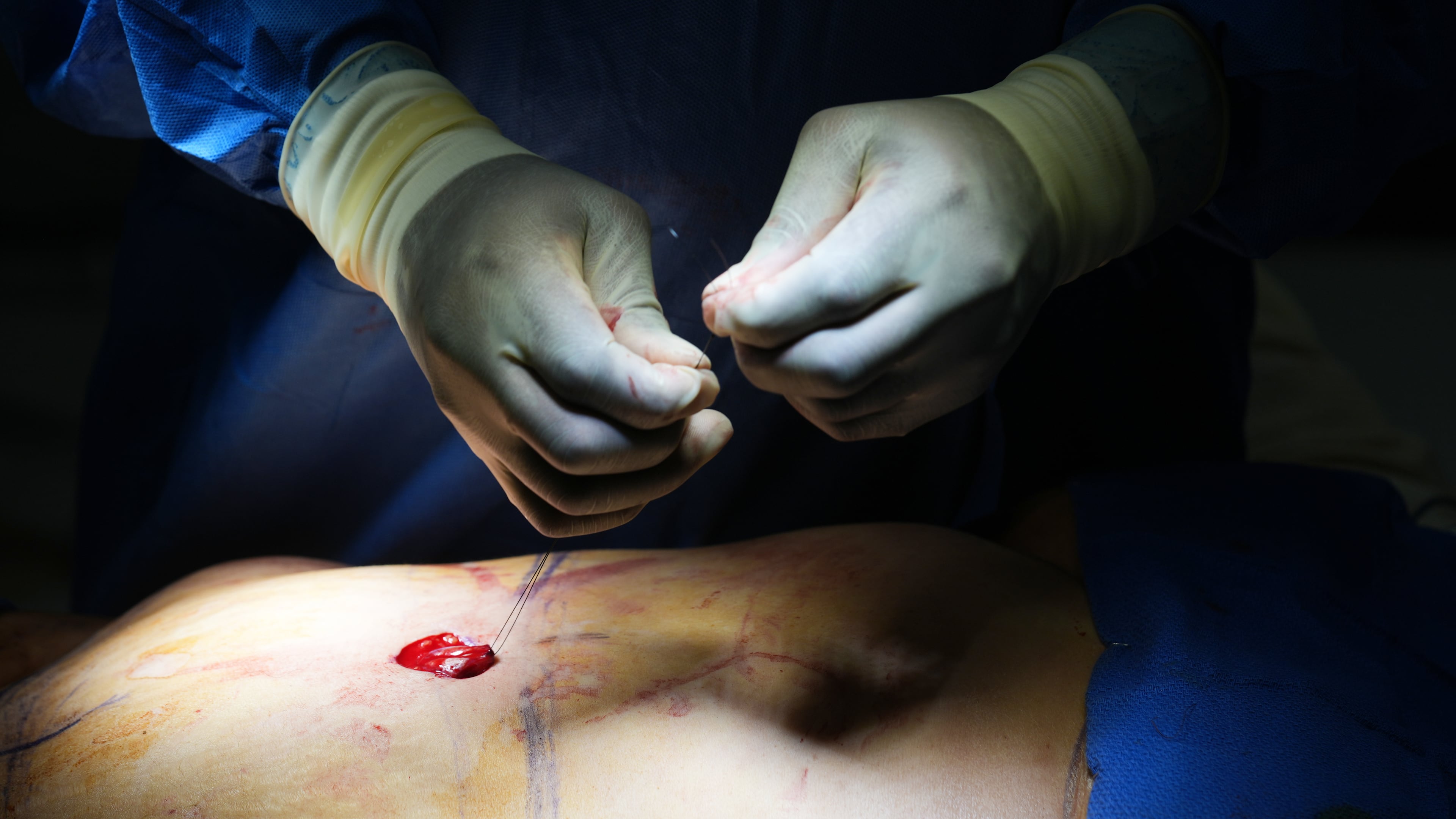 Plastic surgeon Dr. Michael Obeng performs a belly bottom reconstruction plastic surgery after a tummy tuck at a surgical center in Beverly Hills, Calif., on Thursday, Feb. 5, 2026. (AP Photo/Damian Dovarganes)