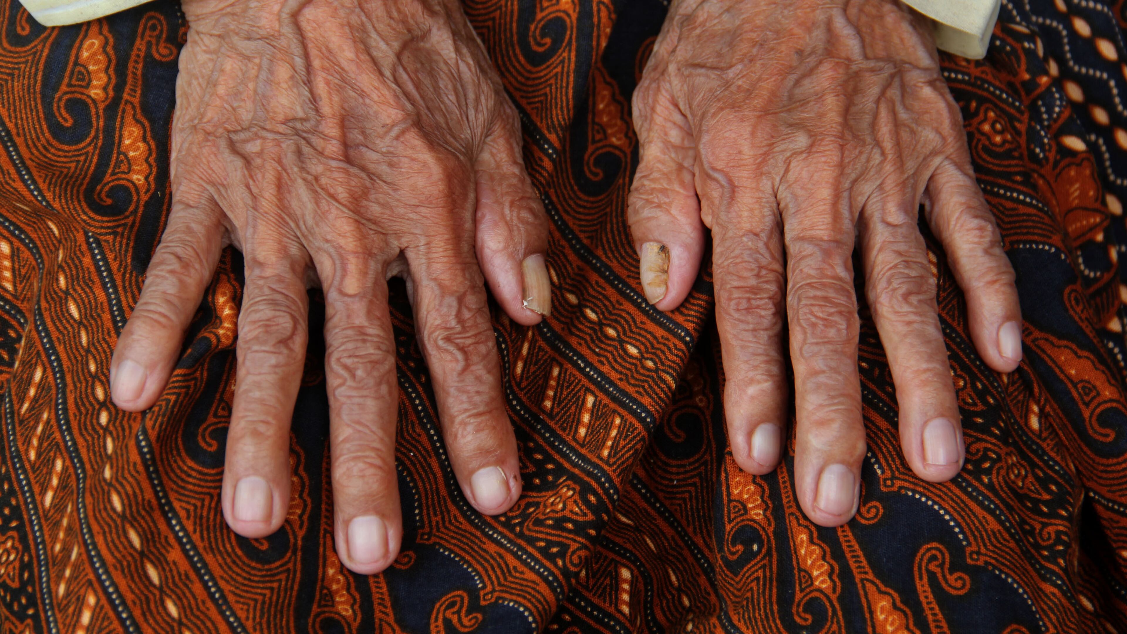 PURWAKARTA, INDONESIA - MAY 15: Anami shows her wrinkled fingers May 15, 2015 in Purwakarta, Indonesia. According to members of her family, Anami is believed to be 140 years old and is set to be put through a thorough medical examination as part of the World's Oldest Woman contest in Russia. Anami has had to meet with the District Head of Purwakarta to request his support to attend the competition in which the winner will receive Rp 13 billion. The world's current oldest known living person is 115-year-old Jeralean Talley of the U.S. (Photo by Nurcholis Anhari Lubis/Getty Images)