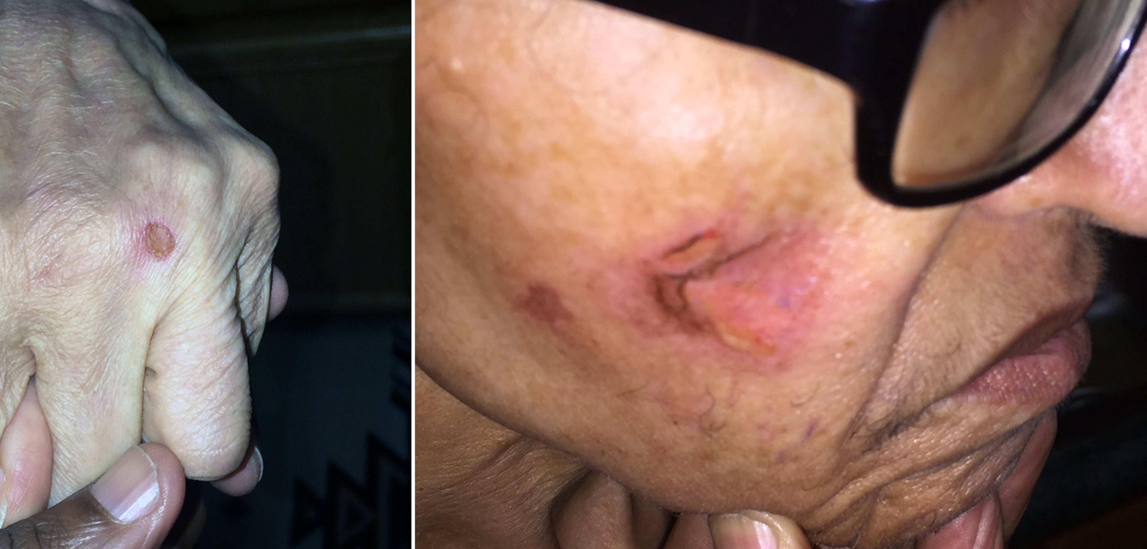 Jacquelyn Stafford suffered burns on her hand and her face when spending a week at Hapeville Manor. In a lawsuit, her son contends that a caregiver there burned her repeatedly with a cigarette.