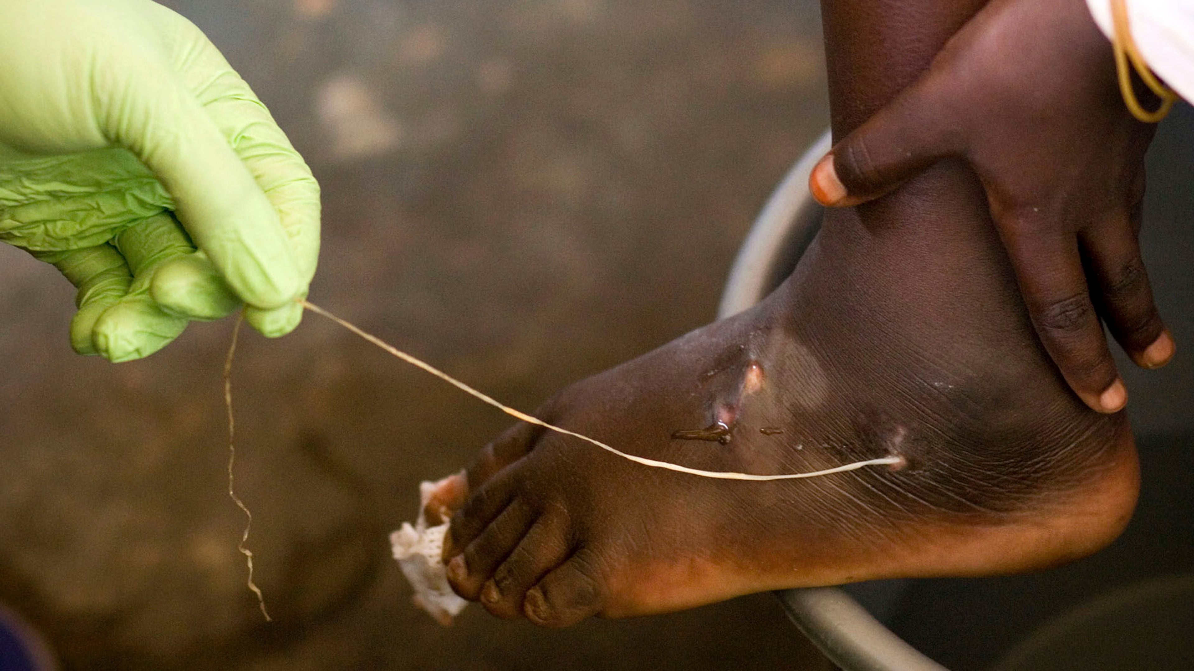 FILE - In this March 9, 2007 file photo, a guinea worm is extracted by a health worker from a child's foot at a containment center in Savelugu, Ghana. (AP Photo/Olivier Asselin, File)